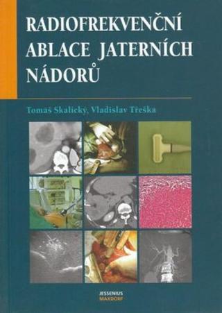 Radiofrekvenční ablace jaterních nádorů - Vladislav Třeška, Tomáš Skalický